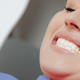 Hoe krijg je witte tanden